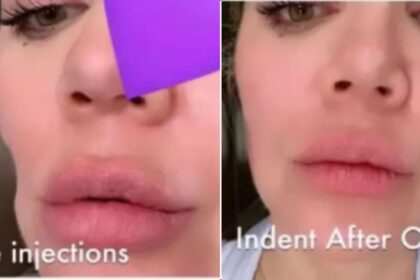 Khloé Kardashian Reveals Cheek Filler After Skin